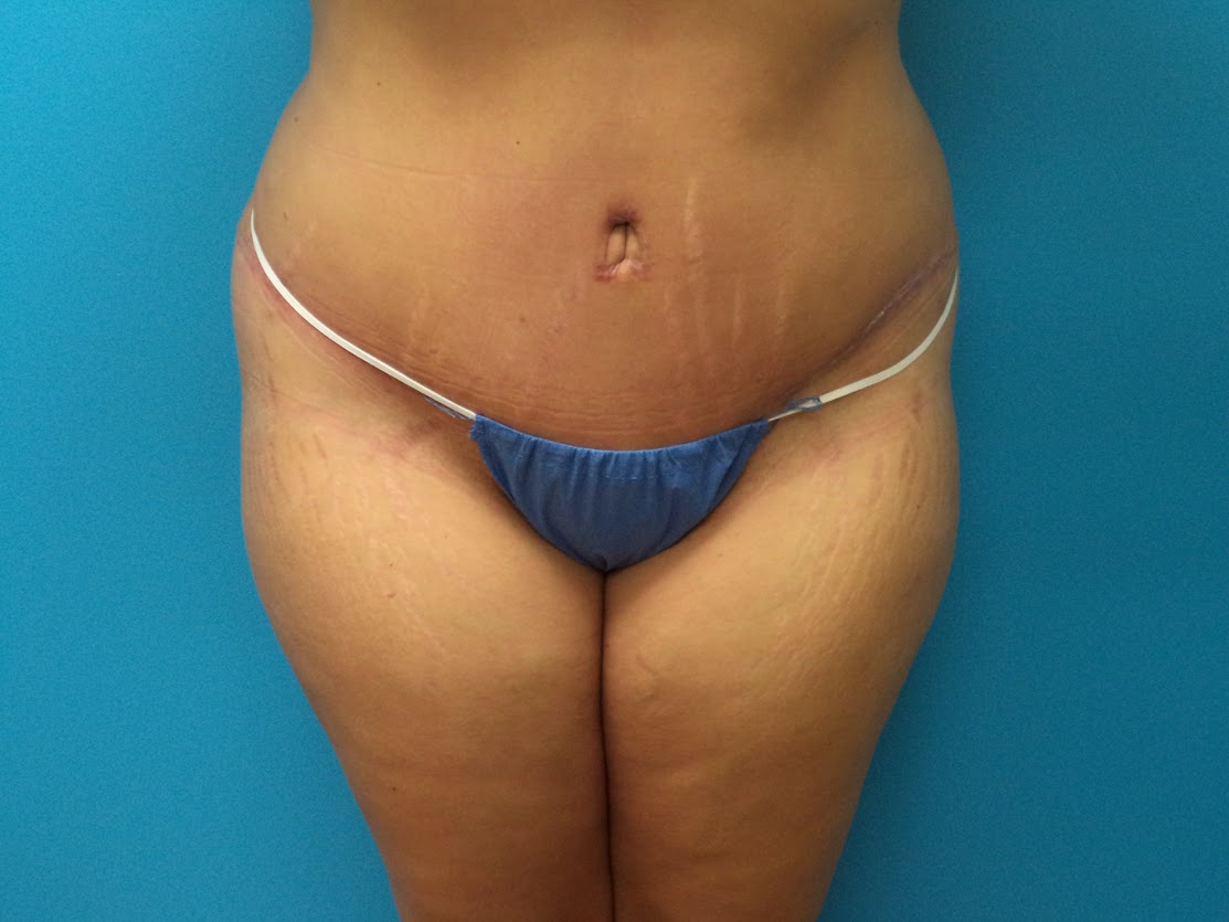 Tummy Tuck patient 2 after