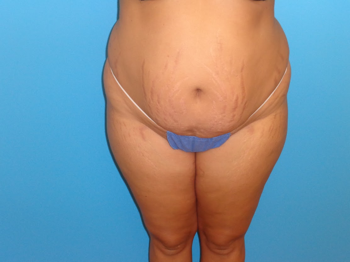 Tummy Tuck patient 2 before