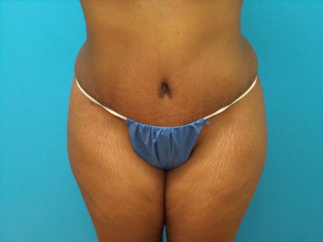 Tummy Tuck patient 4 after