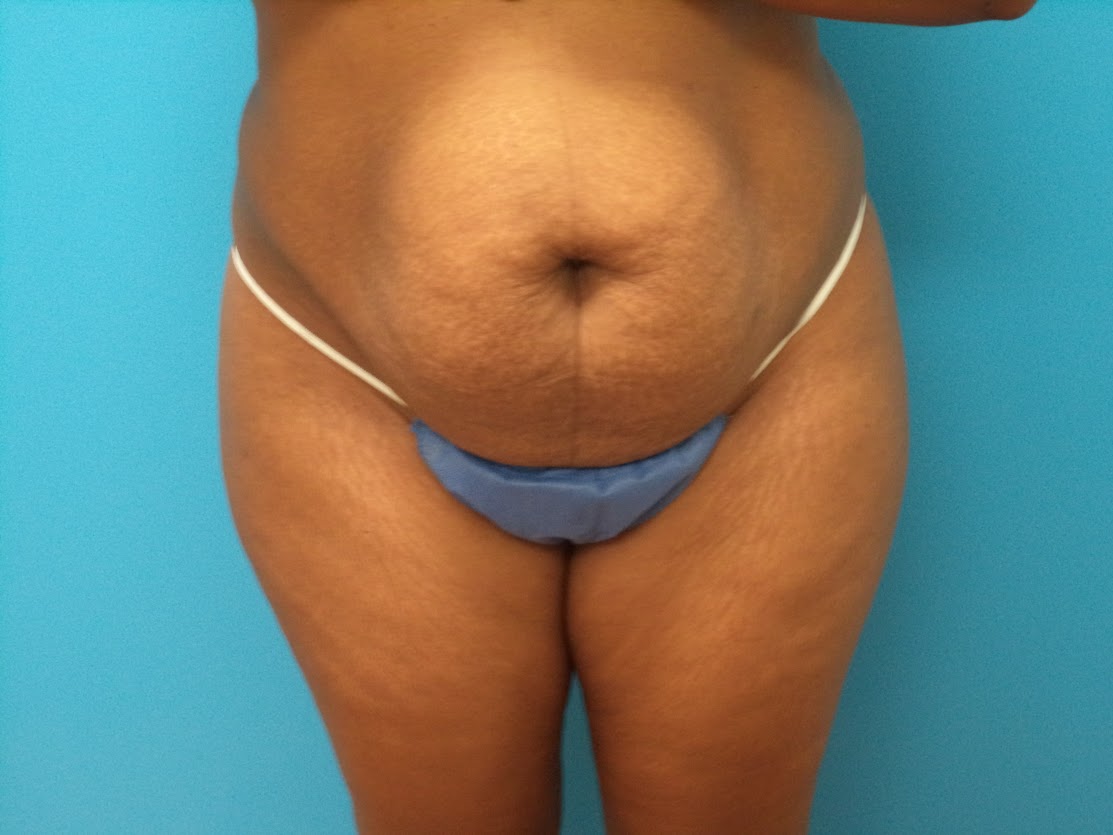 Tummy Tuck patient 4 before