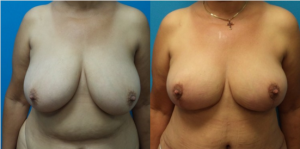 Before and After Breast Reduction
