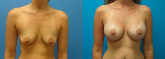 How to Prepare for Your Breast Augmentation Consultation - Featured Image
