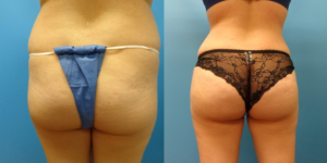 5 Reasons a Brazilian Butt Lift Is Better Than Butt Implants - Featured Image