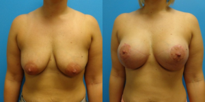 before-and-after-breast-lift