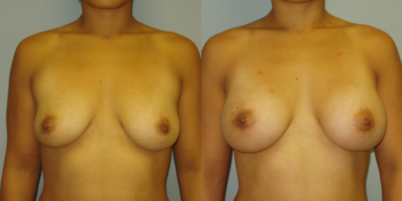 Which Breast Implants Look the Most Natural? - Featured Image