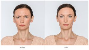 Woman Showing BOTOX® Cosmetic Before and After Photos