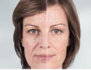 Facial Sculpting With Sculptra® Aesthetic - Featured Image