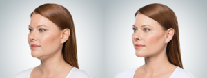 KYBELLA® before and after photos