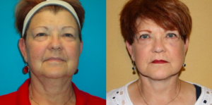 What Does a Facelift Do? - Featured Image