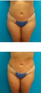 Liposuction vs. Tummy Tuck Surgery - Featured Image
