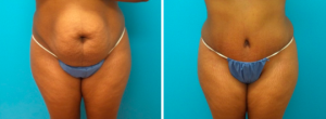 Combining Abdominoplasty With Liposuction - Featured Image