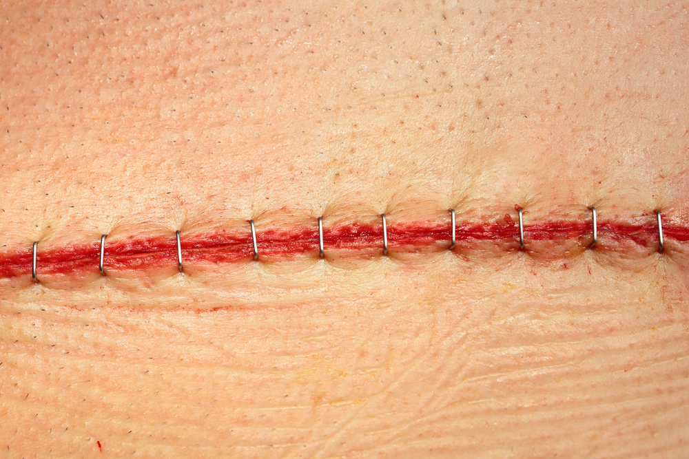 Close Up of Surgical Staples