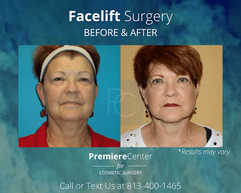 Before and after image showing the results of a facelift performed in Tampa, FL.