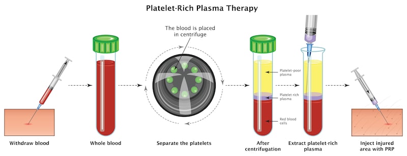 Illustration of the PRP therapy process.