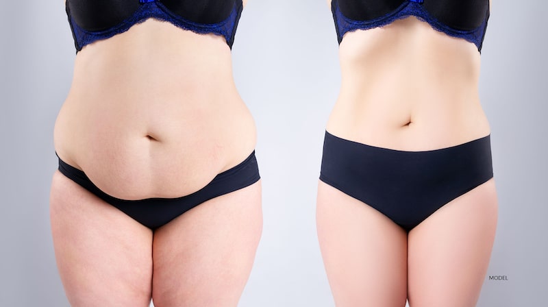 Before and after abdominal contouring photos of a woman wearing black underwear