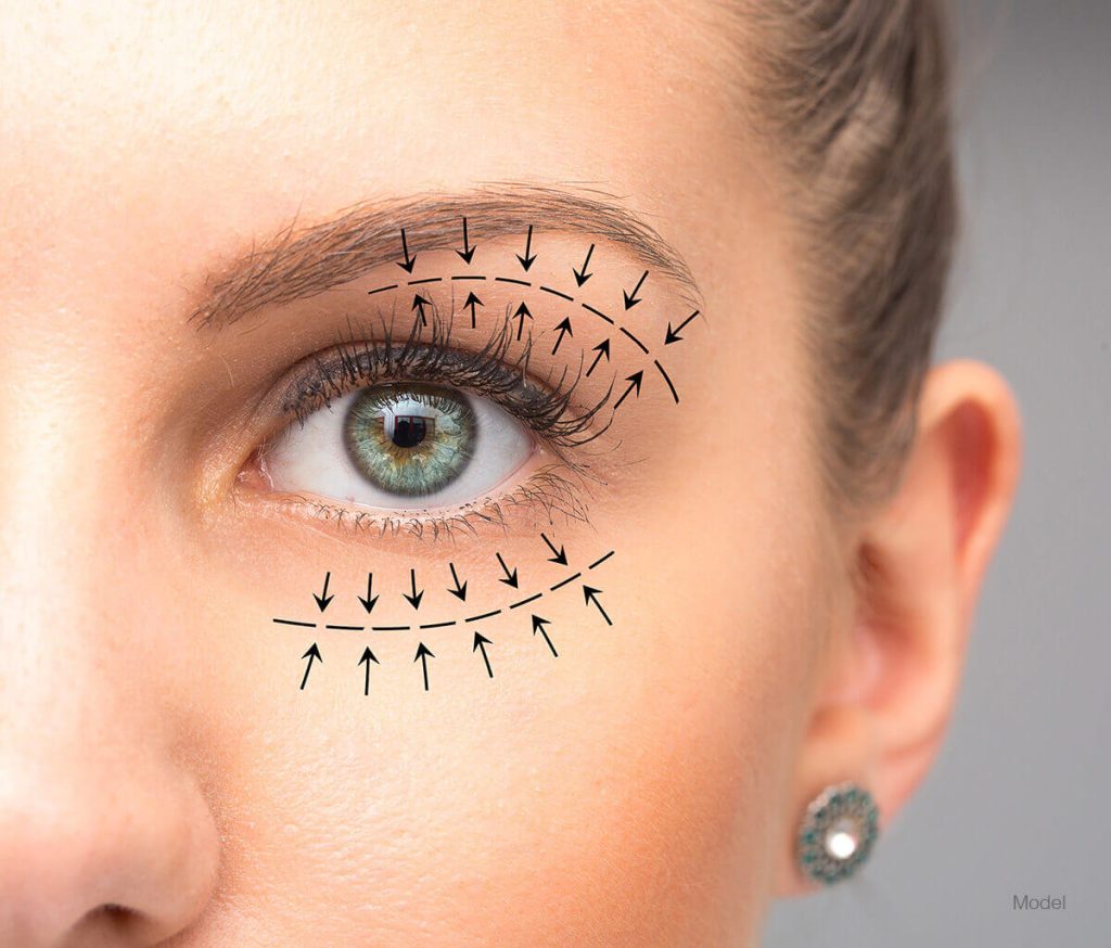 Is There an Age Limit for Eyelid Surgery? - Featured Image