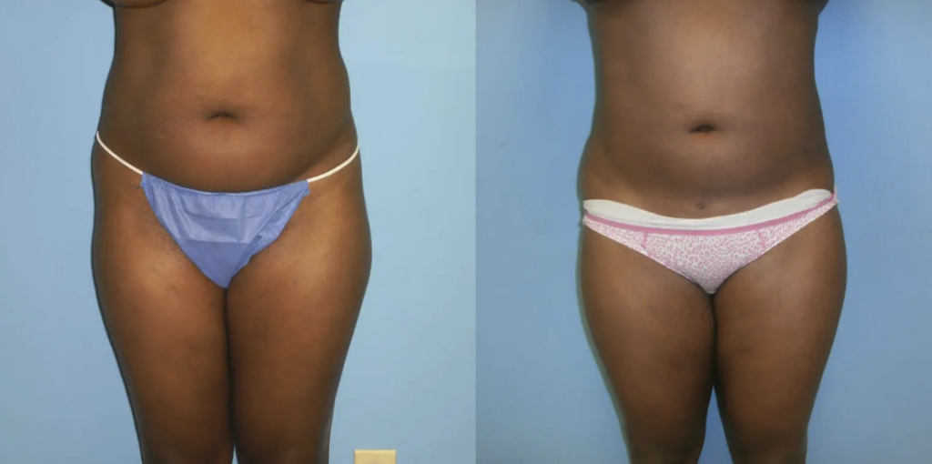 Before and after images of a liposuction patient in Tampa, FL