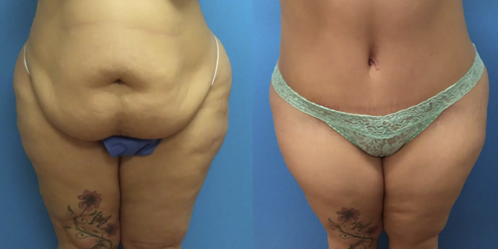 Before and after images of a tummy tuck patient in Tampa, FL