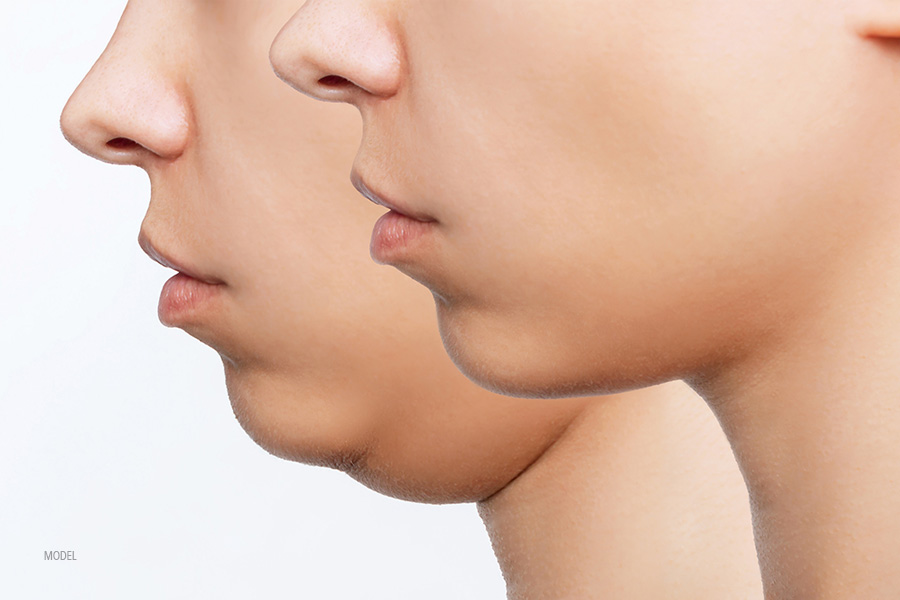 Is KYBELLA® a Permanent Solution to My Double Chin? - Featured Image