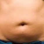 Coolsculpting Before & After Patient #396