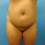 Liposuction Before & After Patient #529