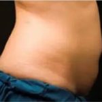 Coolsculpting Before & After Patient #396