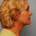 Blepharoplasty Before & After Patient #133