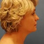 Blepharoplasty Before & After Patient #133