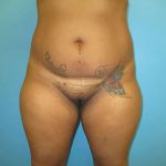 Liposuction Before & After Patient #486