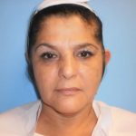 Otoplasty Ear Pinning Before & After Patient #606