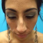 Rhinoplasty Before & After Patient #619