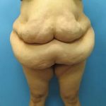 Body Lift Before & After Patient #148