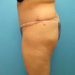 Body Lift Before & After Patient #148