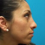 Rhinoplasty Before & After Patient #619