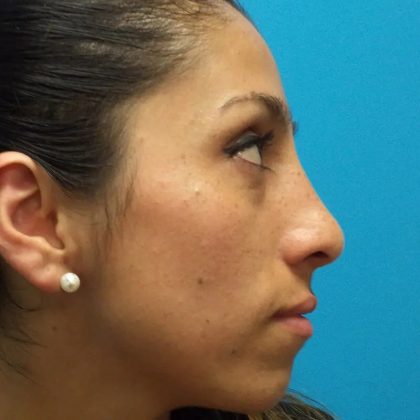 Rhinoplasty Before & After Patient #619
