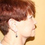 Facelift Before & After Patient #411
