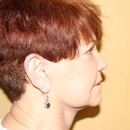 Facelift Before & After Patient #411