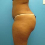 Liposuction Before & After Patient #486