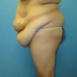 Body Lift Before & After Patient #148
