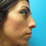 Rhinoplasty Before & After Patient #619