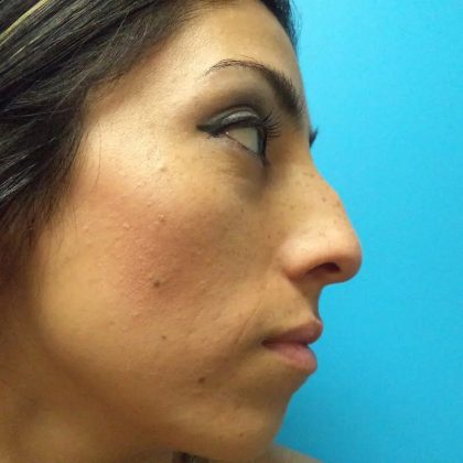 Rhinoplasty Before & After Patient #619