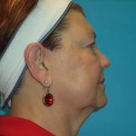 Facelift Before & After Patient #411