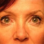 Blepharoplasty Before & After Patient #138