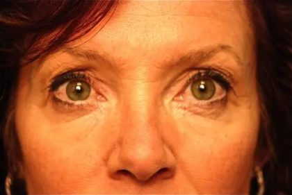 Blepharoplasty Before & After Patient #138