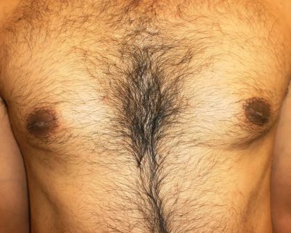 Gynecomastia Before & After Patient #453