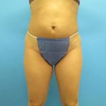 Liposuction Before & After Patient #491