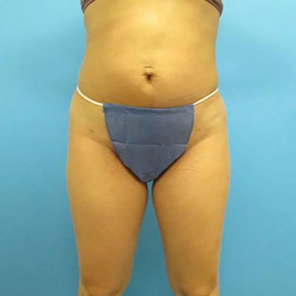 Liposuction Before & After Patient #491