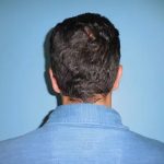Otoplasty Ear Pinning Before & After Patient #609