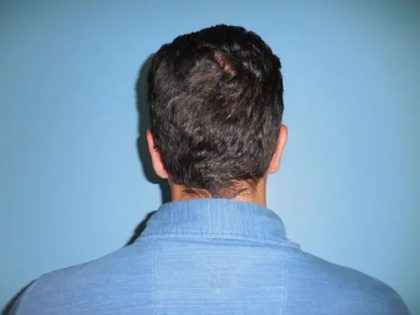 Otoplasty Ear Pinning Before & After Patient #609