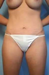 Umbilical Float Before & After Patient #629